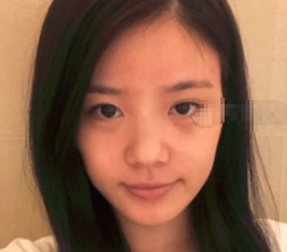 武汉新至美聂祝锋脂肪填充可靠吗?面填案例
