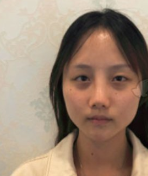 南京美贝尔医疗美容医院埋线提升提升案例分享