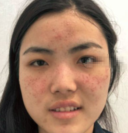 北京欧华医疗美容护肤好不好？光子嫩肤果