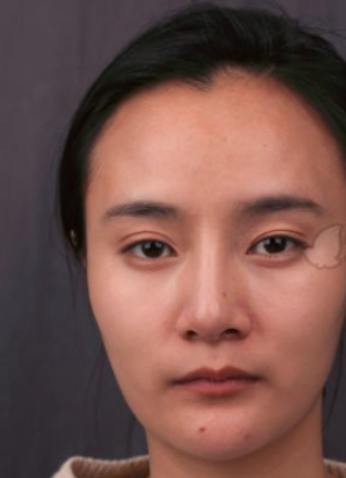 上海华美李志海下颌角整形咋样？有案例吗？