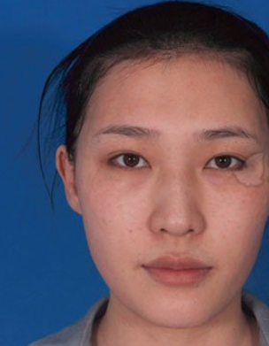 厦门美莱医疗美容隆鼻真的好么？鼻部手术案例