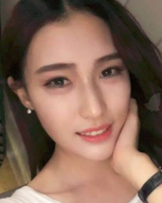 厦门美莱医疗美容隆鼻真的好么？鼻部手术案例