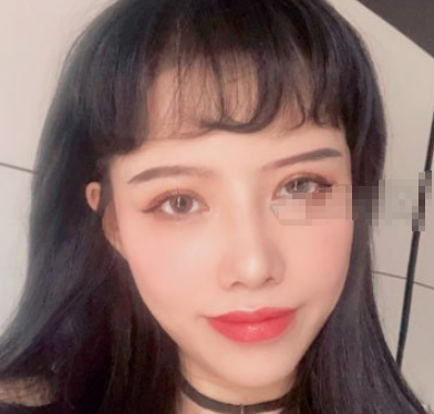 天津伊美尔整形李卫华做双眼皮好吗?案例