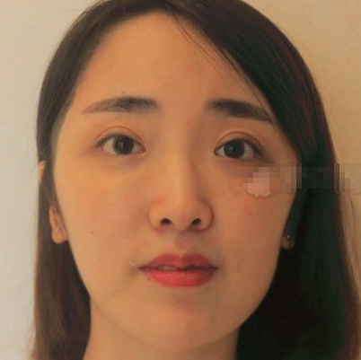 成都艾米丽假体隆鼻咋样啊？看下这个案例吧！