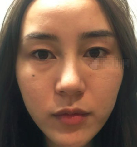 长沙鹏爱医疗美容简介&埋线提升提升案例附对比图