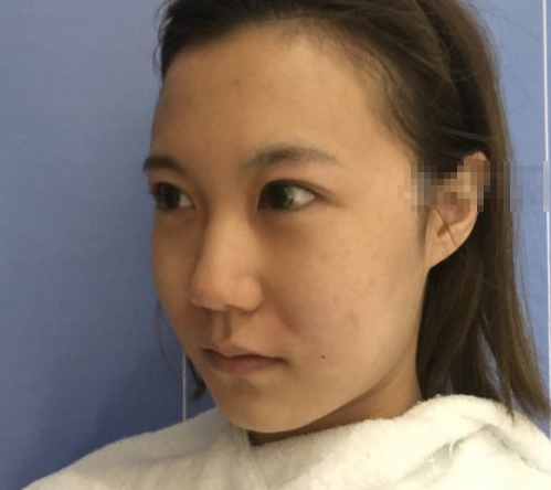 北京和颜美帕医疗美容埋线提升提升案例分享！