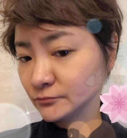 宁夏华美整形美容注射注射瘦脸怎么样？