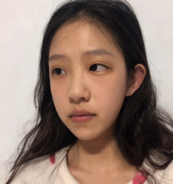 杭州美莱医疗美容医生韩超鼻部手术案例分享!