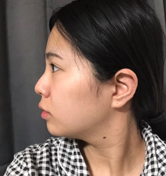 DA整形外科医院下颌角整形手术案例分享!