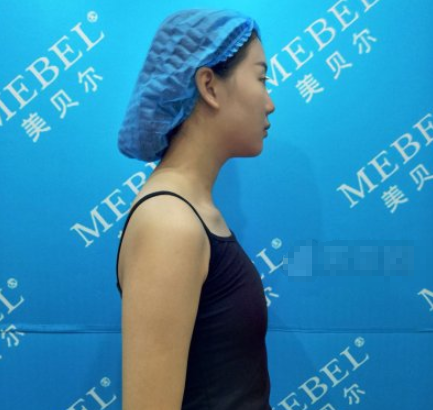 南京美贝尔整形医院自体脂肪隆胸案例分享!
