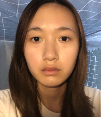丰泽黄惠铭医美医院眼部手术案例分享!