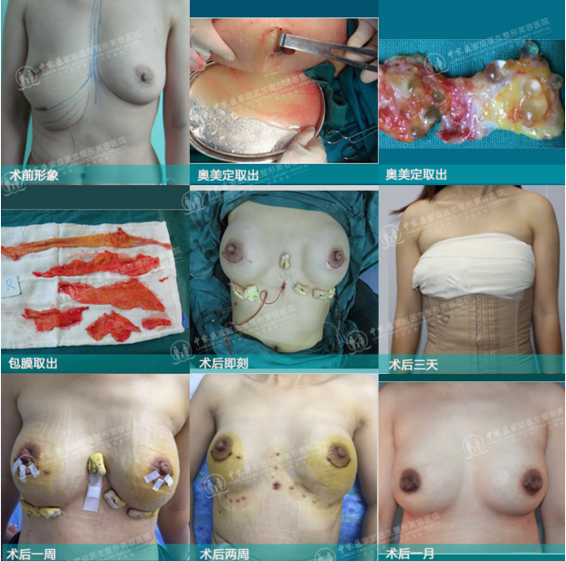 广州中家医家庭医生做奥美定取出修复怎么样?