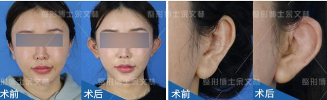 广州高尚整形美容余文林耳再造手术怎么样?