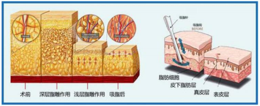 广州高尚整形美容医院韩炜吸脂技术怎么样?