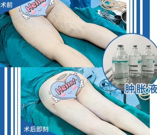广州高尚整形美容医院韩炜吸脂技术怎么样?